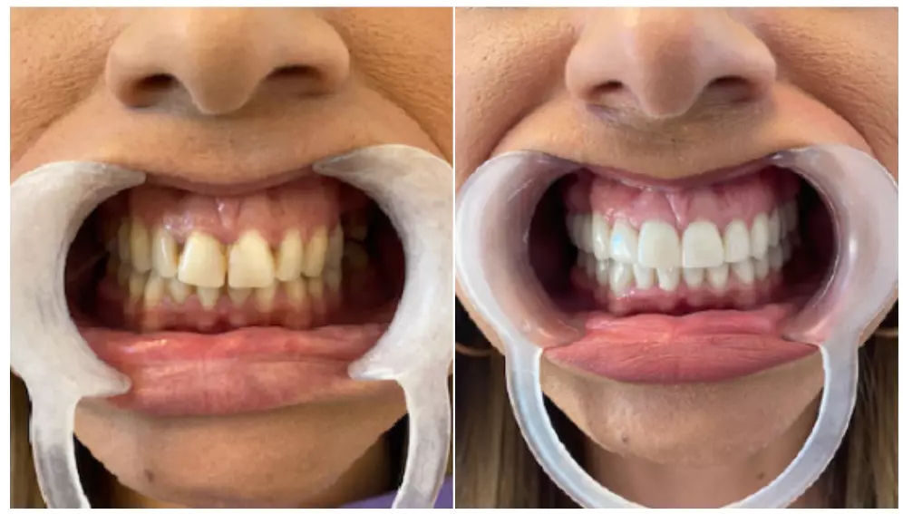 Before and after smile transformation