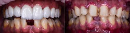 Before and after smile transformation